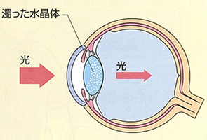 白内障の眼球 /