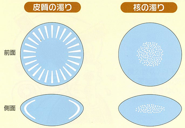 水晶体の濁り方と症状