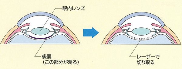 後発白内障のレーザー治療