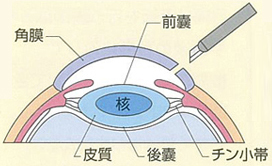 眼球を切開し、水晶体の前囊を切り取る。