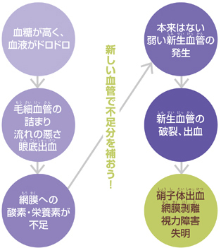 糖尿病と網膜症の関係