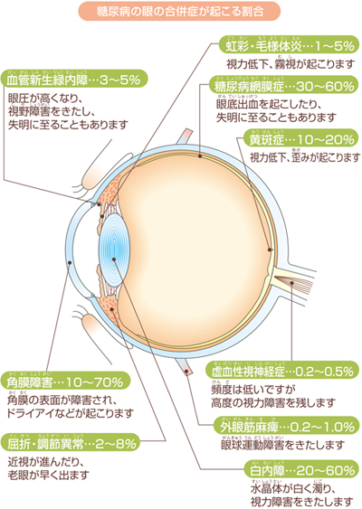 糖尿病の眼の合併症