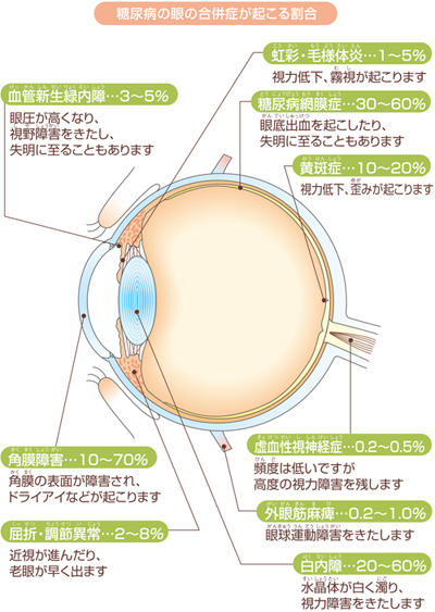 糖尿病の眼の合併症