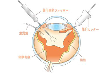 硝子体手術