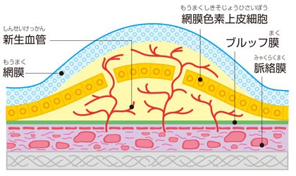 脈絡膜新生血管とは