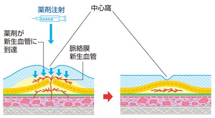 抗VEGF療法