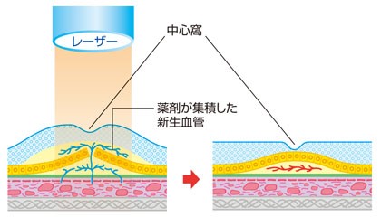 光線力学的療法（PDT）