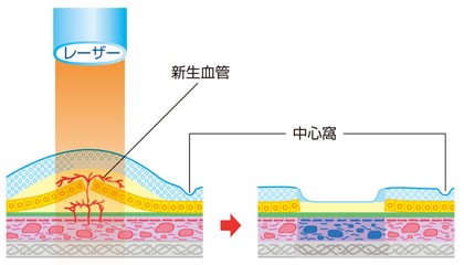 レーザー光凝固術